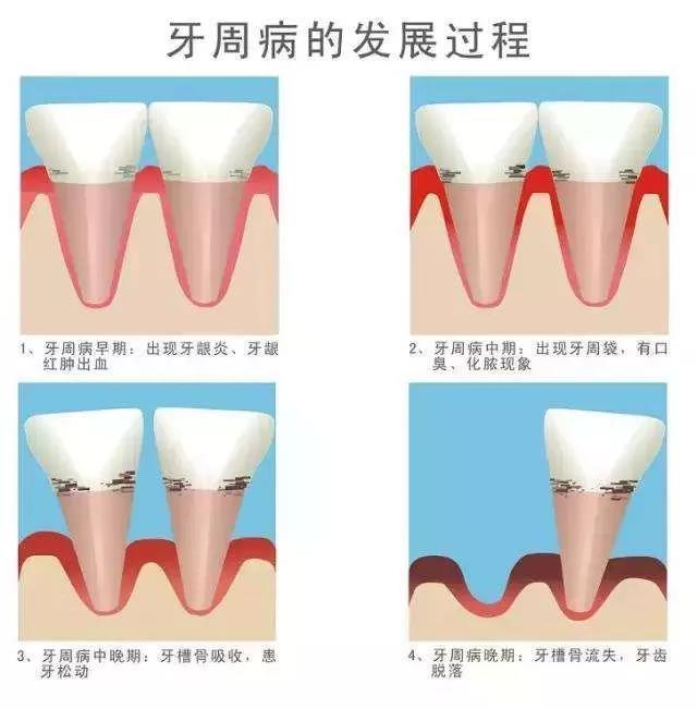 AVECMOI:牙周炎反復(fù)不見好 也許你需要益生菌來幫你